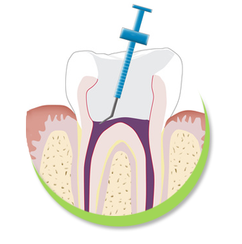 Endodontie Behandlung