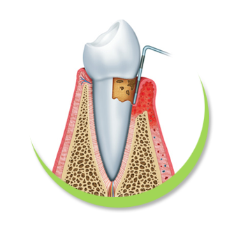 Parodontose Behandlung